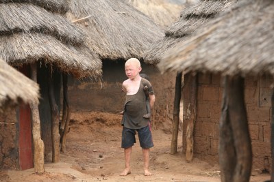 An Albino boy carries a baby.