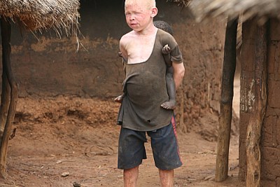 Un petit garçon albinos au nord de l'Ouganda.