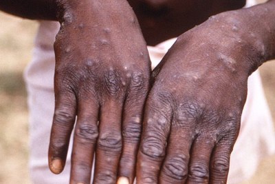 Un jeune homme en République démocratique du Congo, victime de l'épidémie de variole du singe montre ses mains ( photo d'archives).