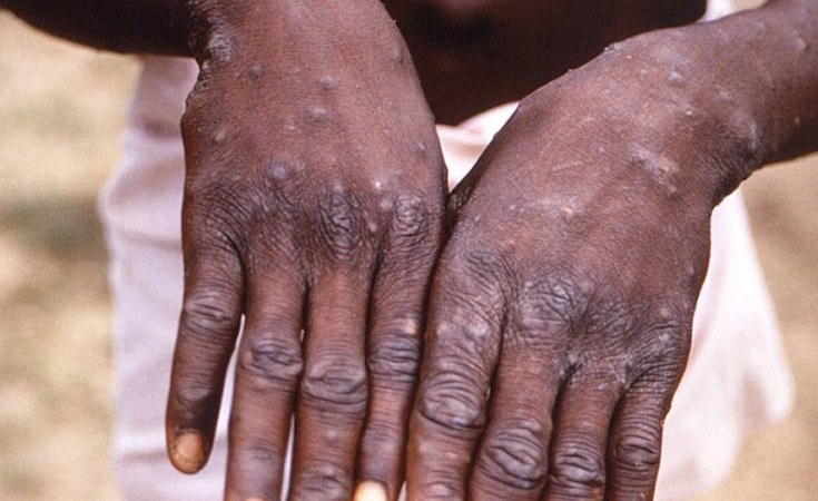Monkeypox: How it spreads, who's at risk - here's what you need to know